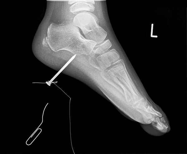 Nail in foot, X-ray C017  /  7980