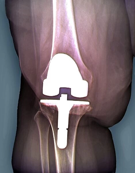 Prosthetic knee and obesity, X-ray C016  /  6595