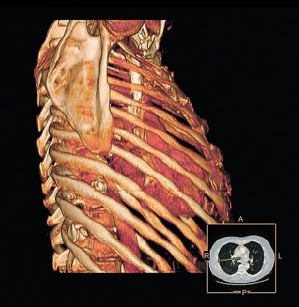 Ribcage and heart, 3D CT scan