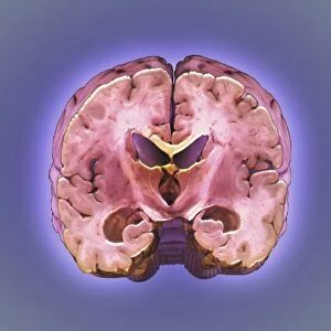 Healthy brain, MRI scan C018 / 0429