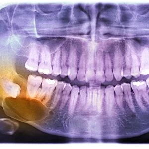 Impacted wisdom tooth, panoral X-ray