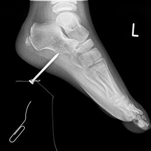 Nail in foot, X-ray C017 / 7980